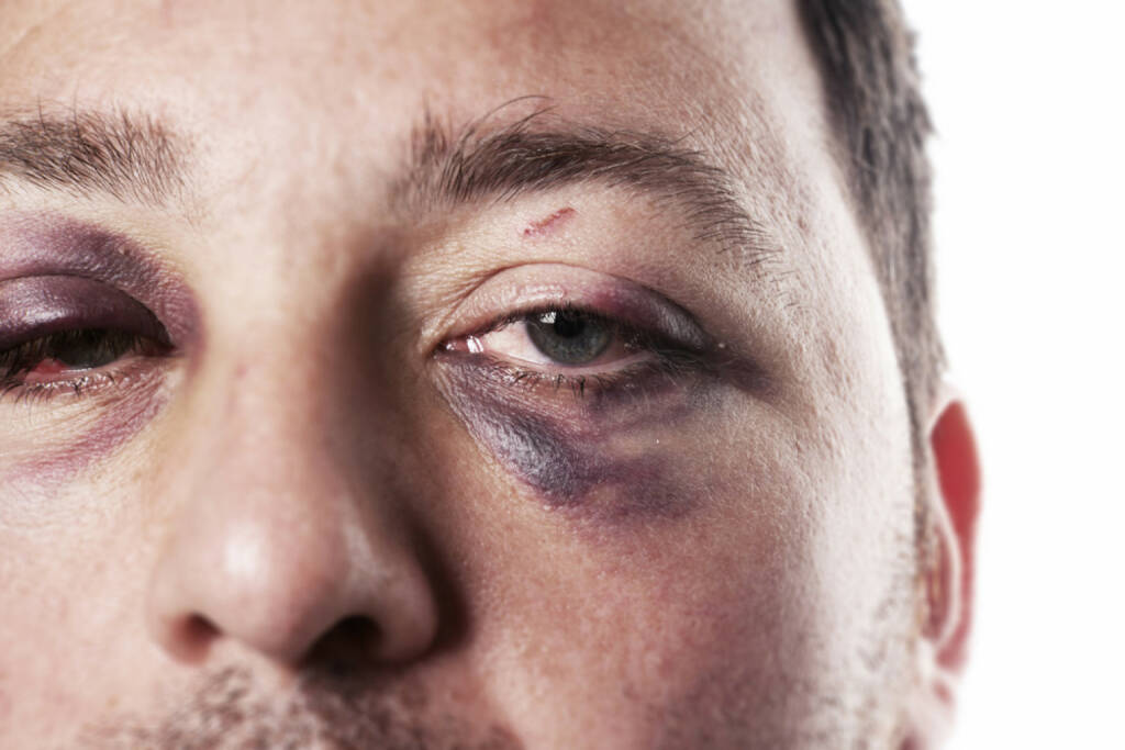 blaues Auge, Auge, Schmerz, davonkommen, crash, Unfall, verletzt, aua, http://www.shutterstock.com/de/pic-106680602/stock-photo-eye-injury-male-with-black-eye-isolated-on-white-man-after-accident-or-fight-with-bruise.html , © (www.shutterstock.com) (25.07.2014) 