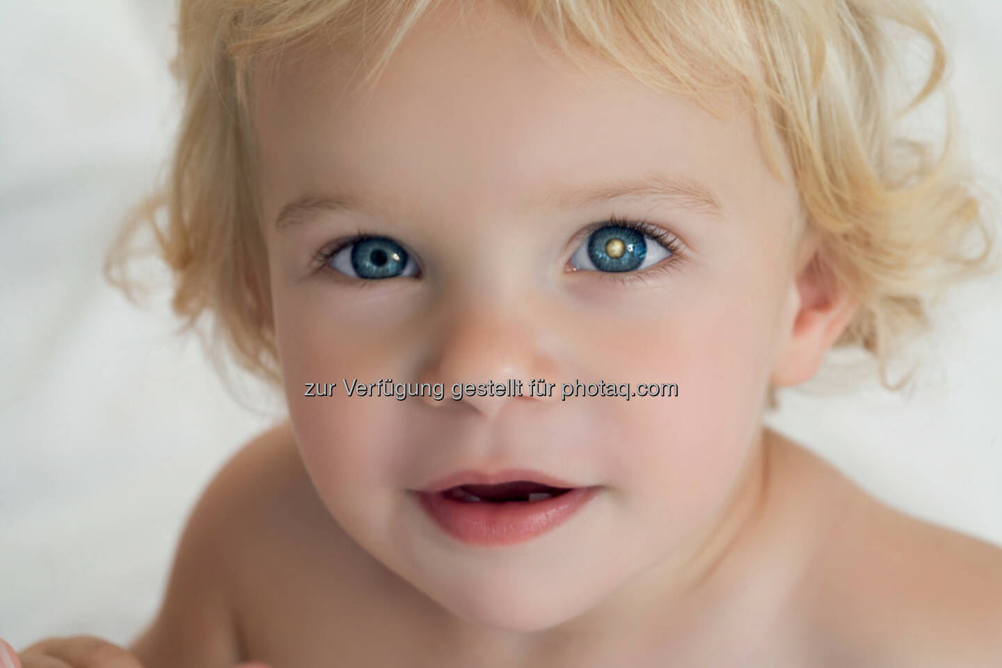 Weiße Pupille auf Blitzlichtfotos ist Warnzeichen von Augenkrebs bei Kindern - Österreichische Kinder-Krebs-Hilfe: „Weiß sehen.“ – Aufklärung für Eltern über Augenkrebs bei Kindern (Fotocredit: KinderAugenKrebsStiftung)